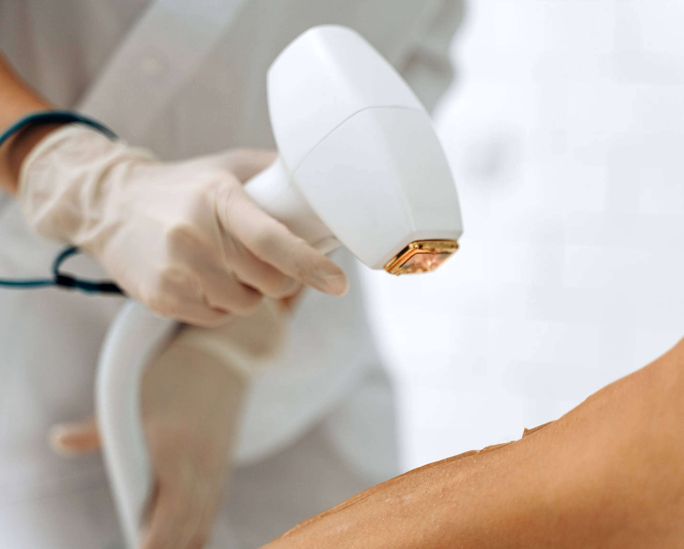 Laser hair removal treatment being performed