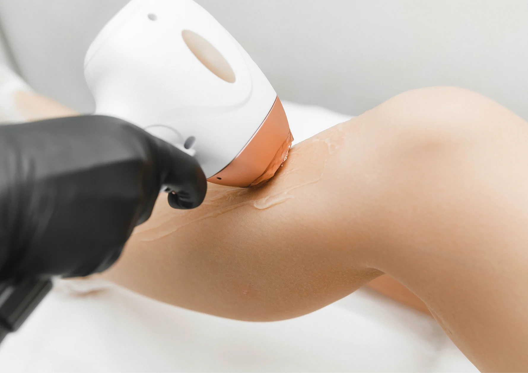 Laser hair removal on the underarm