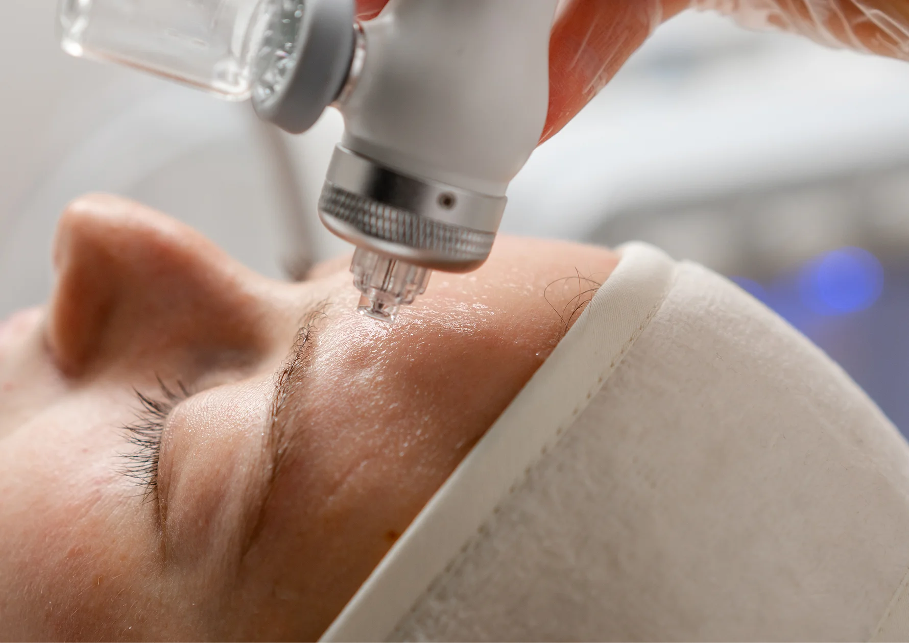 Micro needling treatment on the forehead